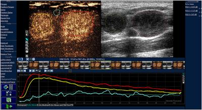 The Value of CEUS in Distinguishing Cancerous Lymph Nodes From the Primary Lymphoma of the Head and Neck